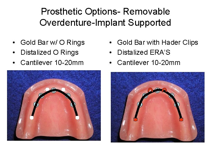 Prosthetic Options- Removable Overdenture-Implant Supported • Gold Bar w/ O Rings • Distalized O