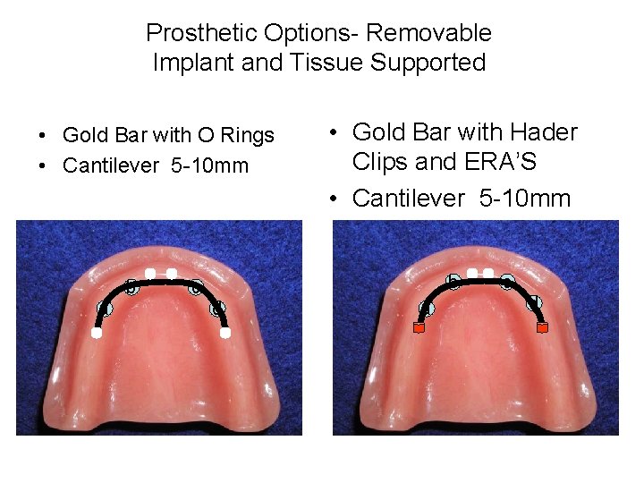 Prosthetic Options- Removable Implant and Tissue Supported • Gold Bar with O Rings •