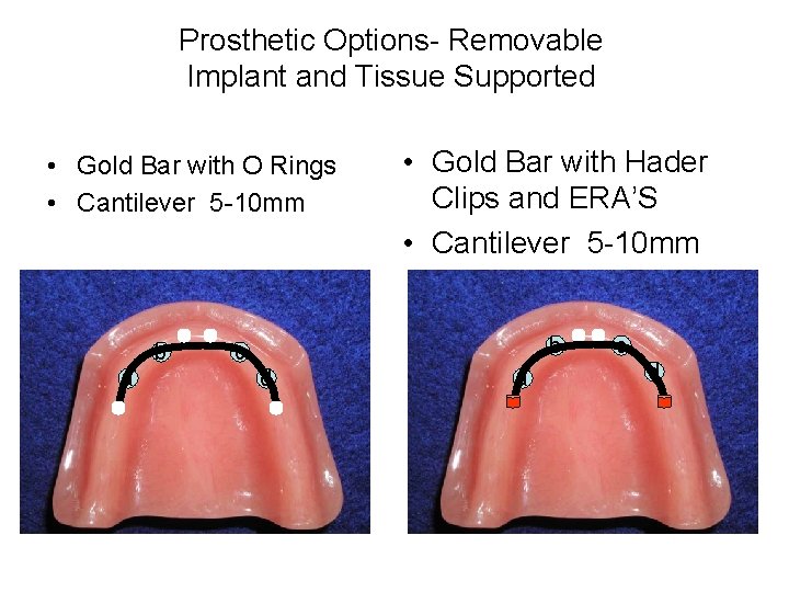 Prosthetic Options- Removable Implant and Tissue Supported • Gold Bar with O Rings •