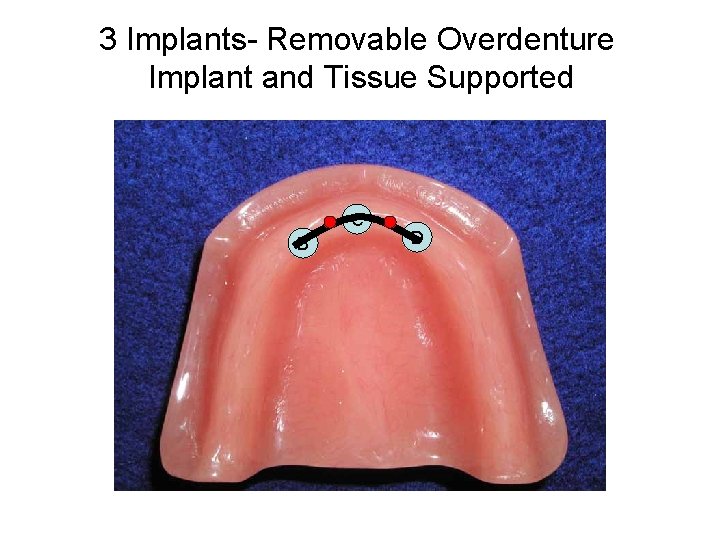 3 Implants- Removable Overdenture Implant and Tissue Supported C B D 