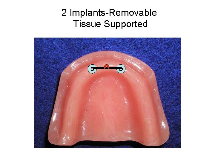 2 Implants-Removable Tissue Supported B D 