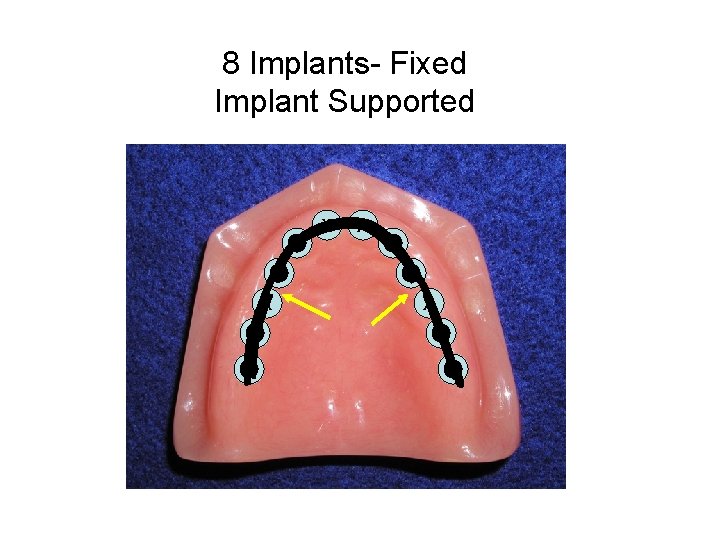 8 Implants- Fixed Implant Supported 7 6 X 4 3 X X 10 11