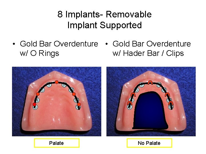 8 Implants- Removable Implant Supported • Gold Bar Overdenture w/ O Rings w/ Hader