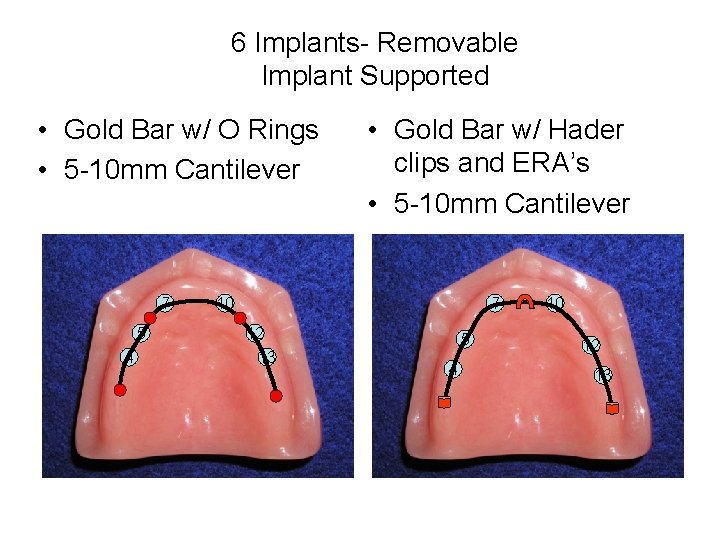 6 Implants- Removable Implant Supported • Gold Bar w/ O Rings • 5 -10