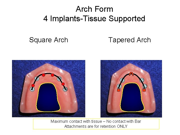 Arch Form 4 Implants-Tissue Supported Square Arch 6 4 Tapered Arch 11 6 13