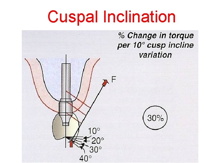 Cuspal Inclination 