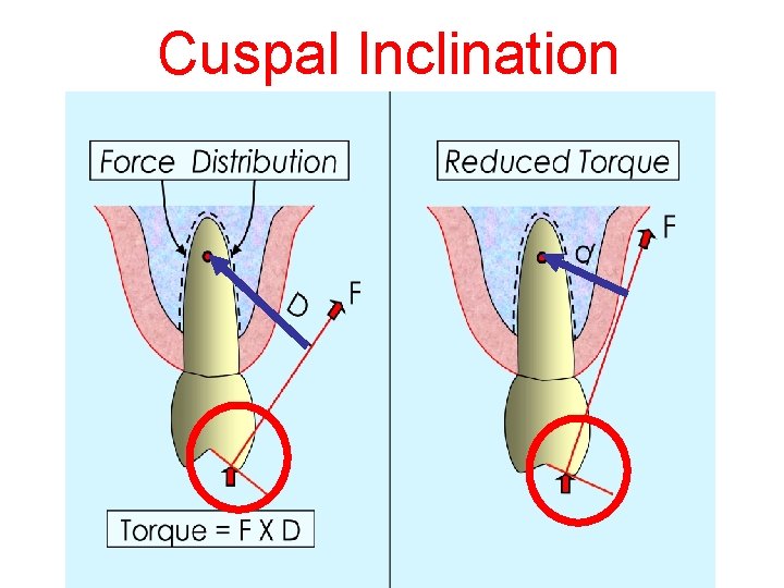 Cuspal Inclination 