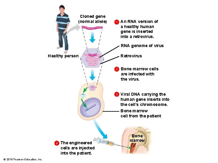 Cloned gene (normal allele) 1 An RNA version of a healthy human gene is