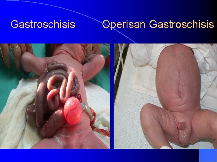 Gastroschisis Operisan Gastroschisis 