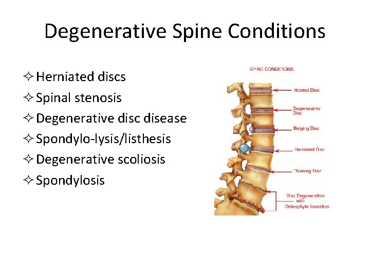 Degenerative Spine Conditions ² Herniated discs ² Spinal stenosis ² Degenerative disc disease ²