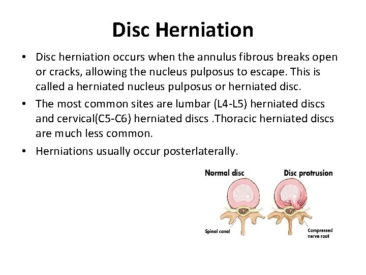 Disc Herniation • Disc herniation occurs when the annulus fibrous breaks open or cracks,