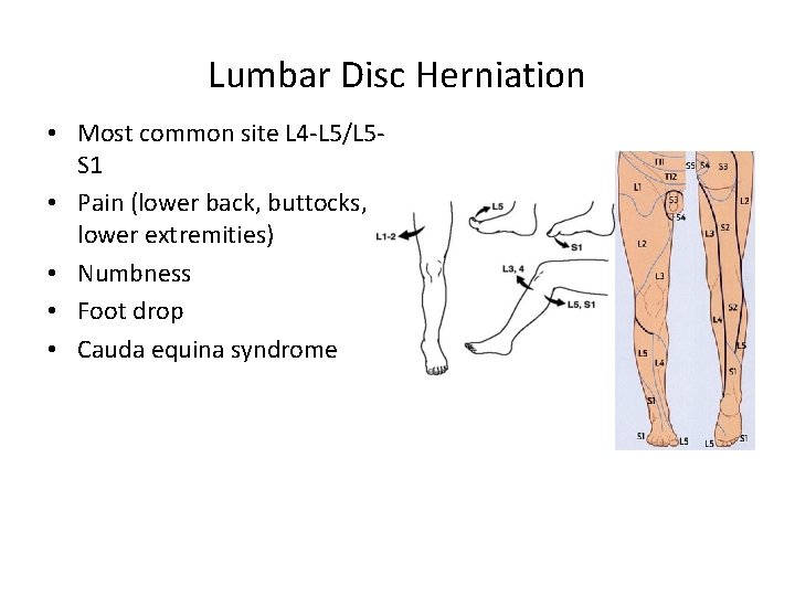 Lumbar Disc Herniation • Most common site L 4 -L 5/L 5 S 1