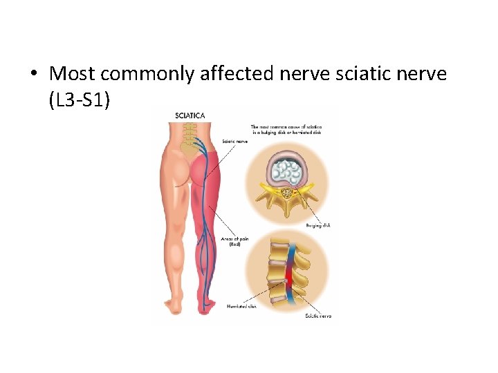  • Most commonly affected nerve sciatic nerve (L 3 -S 1) 