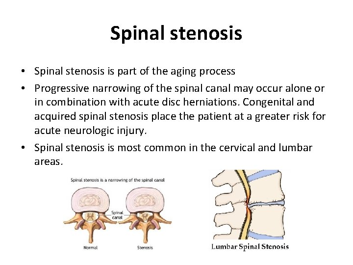 Spinal stenosis • Spinal stenosis is part of the aging process • Progressive narrowing