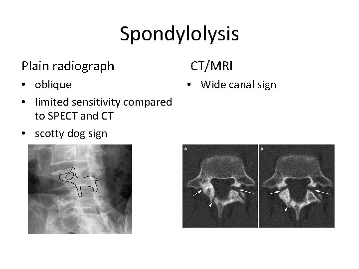 Spondylolysis Plain radiograph CT/MRI • oblique • Wide canal sign • limited sensitivity compared
