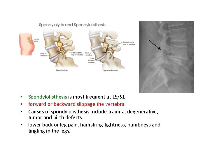  • • Spondylolisthesis is most frequent at L 5/S 1 forward or backward