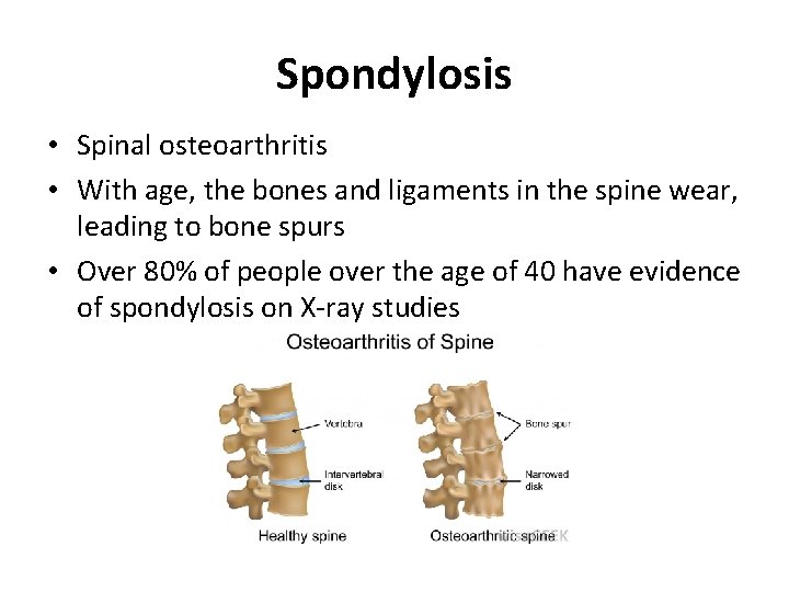 Spondylosis • Spinal osteoarthritis • With age, the bones and ligaments in the spine