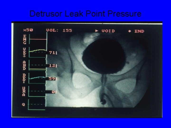 Detrusor Leak Point Pressure 