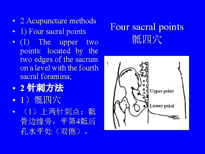  • 2 Acupuncture methods • 1) Four sacral points • (1) The upper