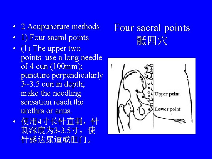  • 2 Acupuncture methods • 1) Four sacral points • (1) The upper