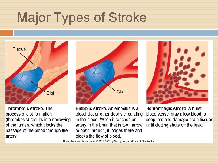 Major Types of Stroke 