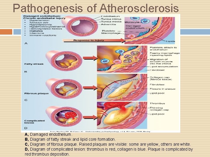 Pathogenesis of Atherosclerosis A, Damaged endothelium. B, Diagram of fatty streak and lipid core