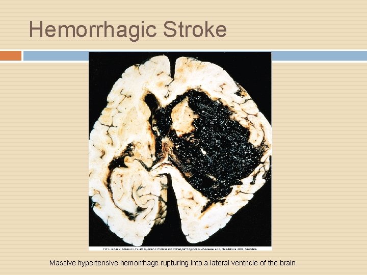 Hemorrhagic Stroke Massive hypertensive hemorrhage rupturing into a lateral ventricle of the brain. 