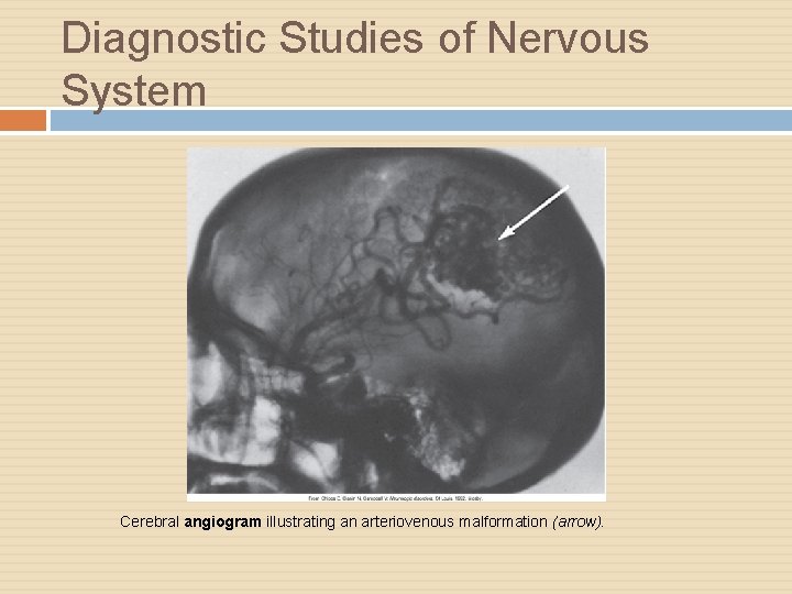 Diagnostic Studies of Nervous System Cerebral angiogram illustrating an arteriovenous malformation (arrow). 