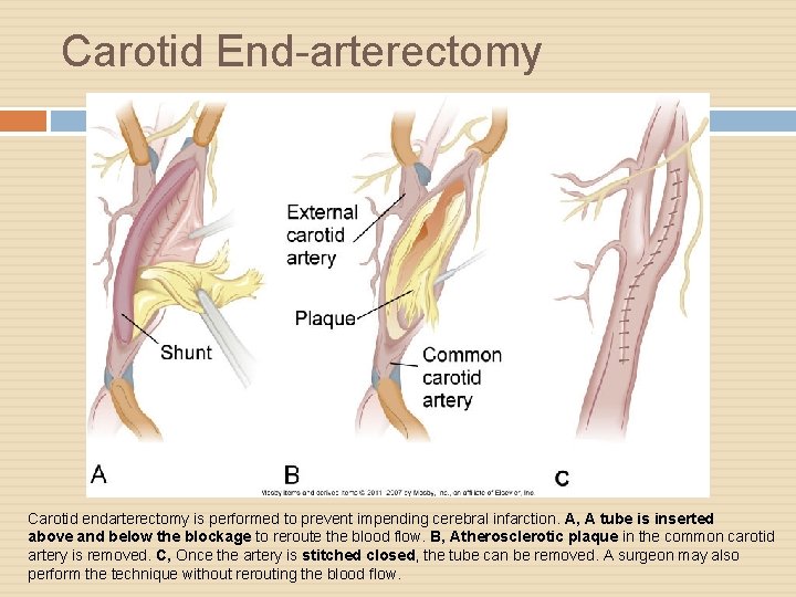 Carotid End-arterectomy Carotid endarterectomy is performed to prevent impending cerebral infarction. A, A tube