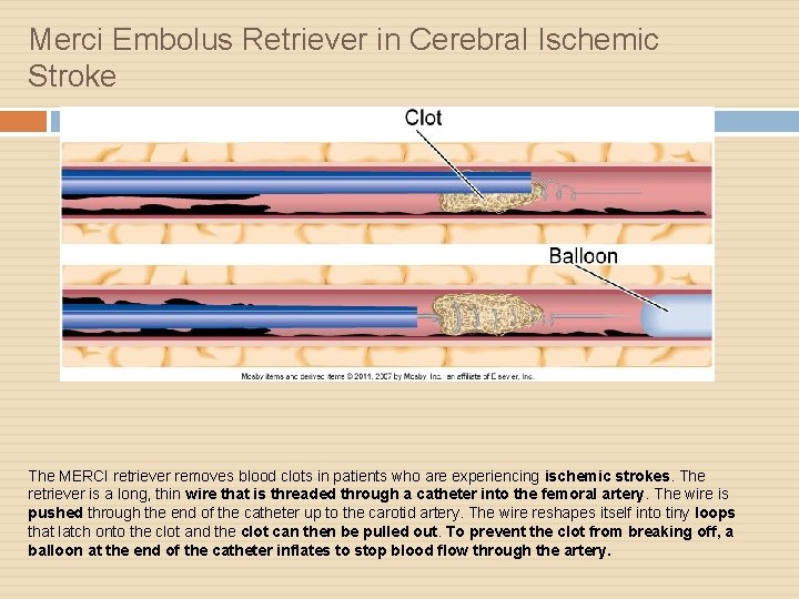 Merci Embolus Retriever in Cerebral Ischemic Stroke The MERCI retriever removes blood clots in