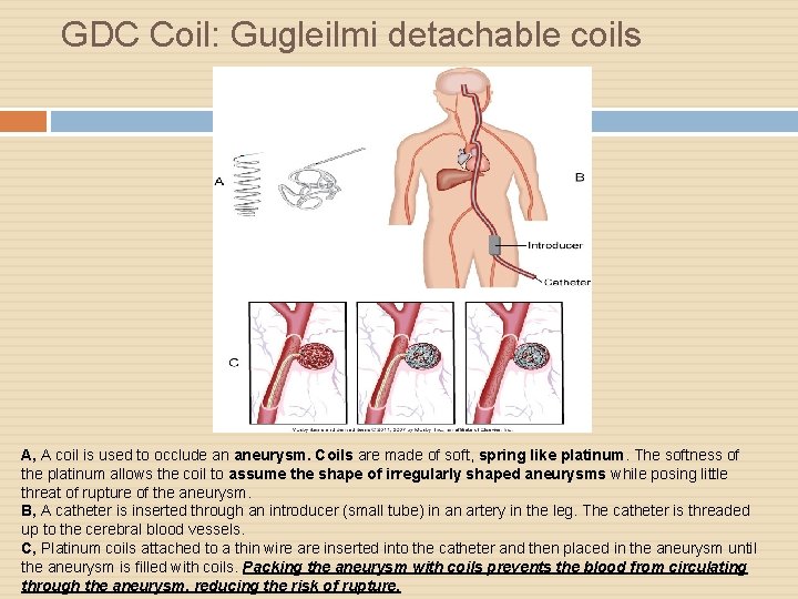 GDC Coil: Gugleilmi detachable coils A, A coil is used to occlude an aneurysm.