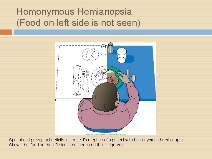 Homonymous Hemianopsia (Food on left side is not seen) Spatial and perceptual deficits in