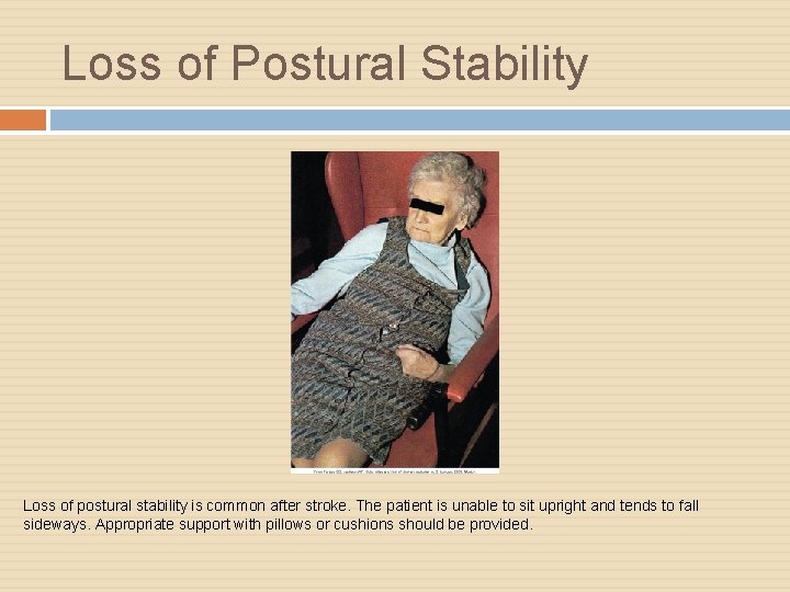 Loss of Postural Stability Loss of postural stability is common after stroke. The patient