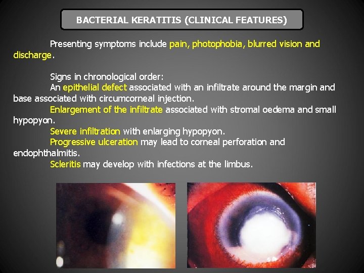 BACTERIAL KERATITIS (CLINICAL FEATURES) Presenting symptoms include pain, photophobia, blurred vision and discharge. Signs