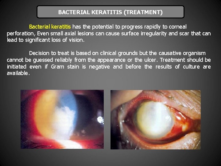 BACTERIAL KERATITIS (TREATMENT) Bacterial keratitis has the potential to progress rapidly to corneal perforation,