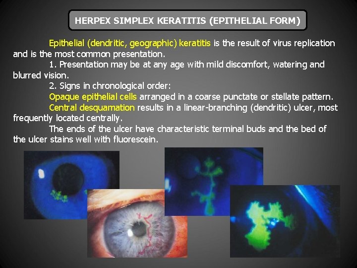 HERPEX SIMPLEX KERATITIS (EPITHELIAL FORM) Epithelial (dendritic, geographic) keratitis is the result of virus