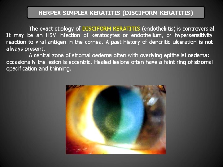 HERPEX SIMPLEX KERATITIS (DISCIFORM KERATITIS) The exact etiology of DISCIFORM KERATITIS (endotheliitis) is controversial.