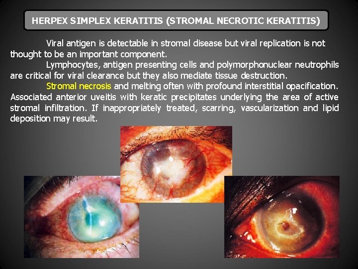 HERPEX SIMPLEX KERATITIS (STROMAL NECROTIC KERATITIS) Viral antigen is detectable in stromal disease but