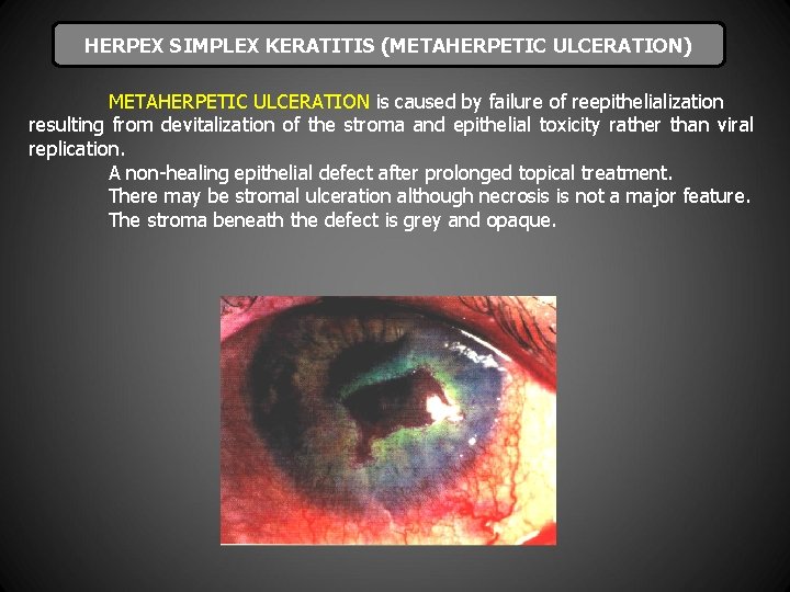 HERPEX SIMPLEX KERATITIS (METAHERPETIC ULCERATION) METAHERPETIC ULCERATION is caused by failure of reepithelialization resulting