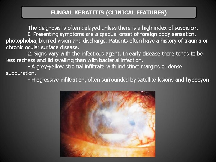 FUNGAL KERATITIS (CLINICAL FEATURES) The diagnosis is often delayed unless there is a high