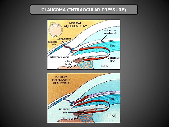 GLAUCOMA (INTRAOCULAR PRESSURE) 