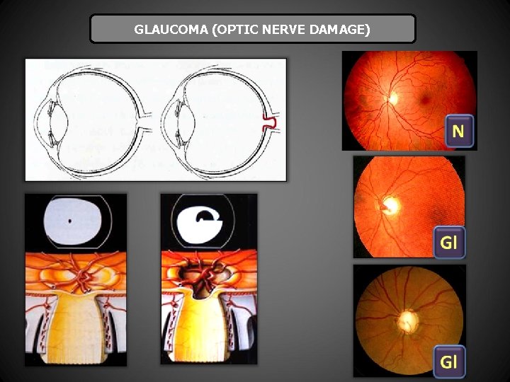 GLAUCOMA (OPTIC NERVE DAMAGE) 