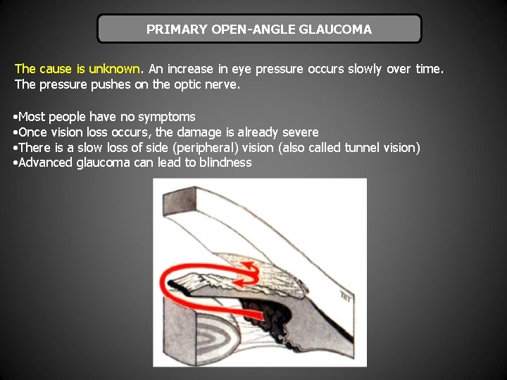 PRIMARY OPEN-ANGLE GLAUCOMA The cause is unknown. An increase in eye pressure occurs slowly