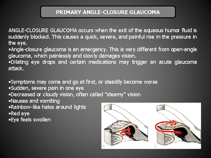 PRIMARY ANGLE-CLOSURE GLAUCOMA occurs when the exit of the aqueous humor fluid is suddenly