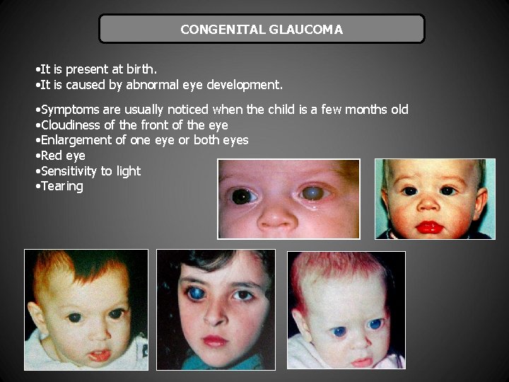 CONGENITAL GLAUCOMA • It is present at birth. • It is caused by abnormal