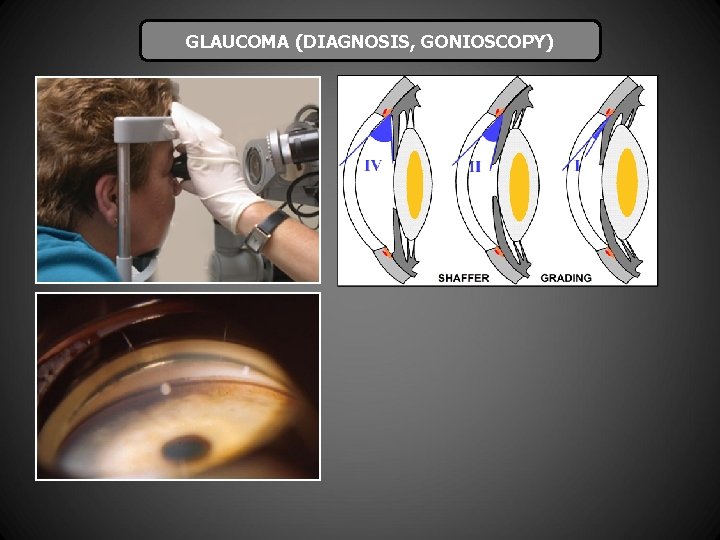 GLAUCOMA (DIAGNOSIS, GONIOSCOPY) 