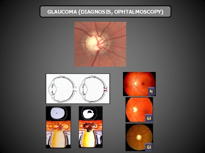 GLAUCOMA (DIAGNOSIS, OPHTALMOSCOPY) 