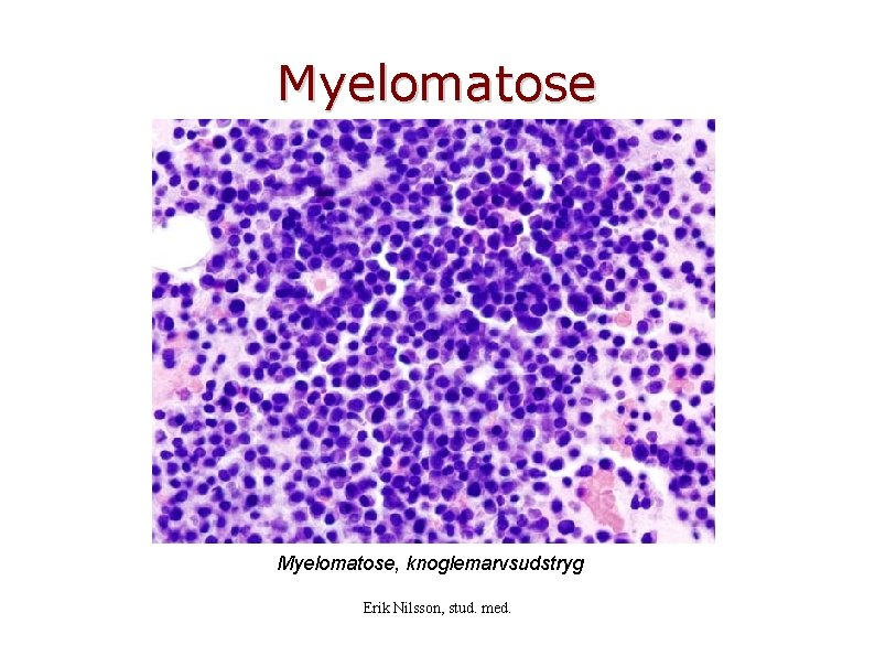 Myelomatose, knoglemarvsudstryg Erik Nilsson, stud. med. 