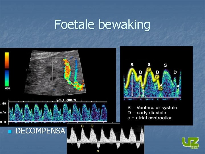 Foetale bewaking n DECOMPENSATIE 