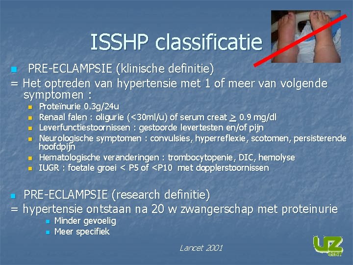 ISSHP classificatie PRE-ECLAMPSIE (klinische definitie) = Het optreden van hypertensie met 1 of meer ISSHP classificatie PRE-ECLAMPSIE (klinische definitie) = Het optreden van hypertensie met 1 of meer
